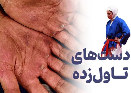 تاول دست‌های طاهره آذرپیوند (عکس)